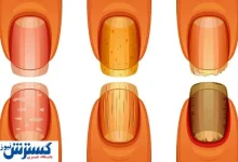تشخیص سرطان ریه از روی ناخن ممکن شد