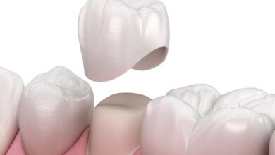 روکش دندان با بیمه (کدام بیمه‌ هزینه روکش دندان را پوشش می‌ دهد؟)